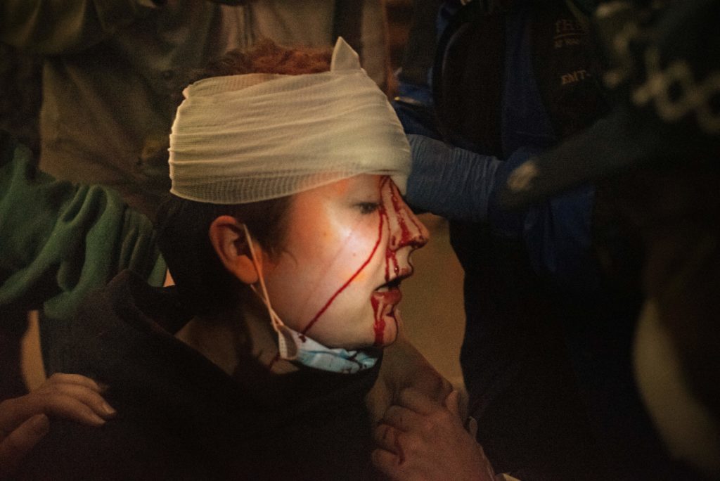 Michaela Staggs, 20, of Santa Rosa, Calif. bleeding from her head after getting hit with a chalk round a little after midnight while she stood with group of Black Lives Matter protesters near a line of police in riot gear on Mendocino Ave. & 7th Street in downtown Santa Rosa, Calif. May 31, 2020. (Erik Castro/ for The Press Democrat)